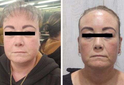 BOTOX WITH MESOTHERAPY AND VAMPIRE (PRP)