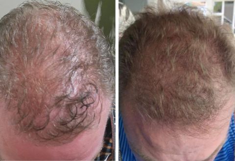 HAIR REGROWTH: MINOXIDIL FENASTERIDE, PRP AND PEPTIDE
